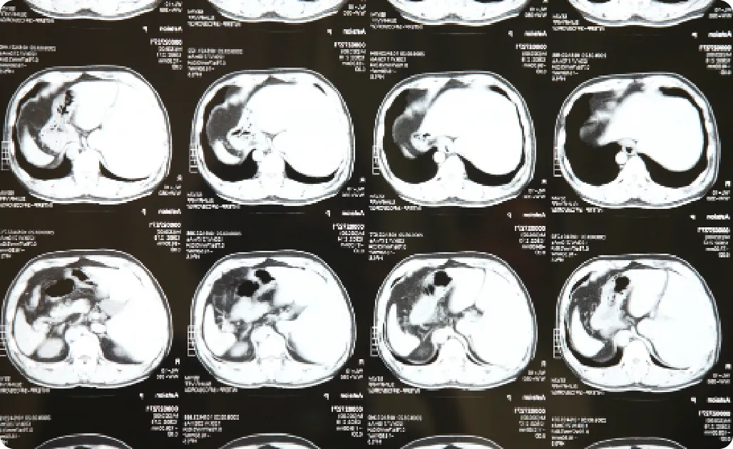 レントゲン写真